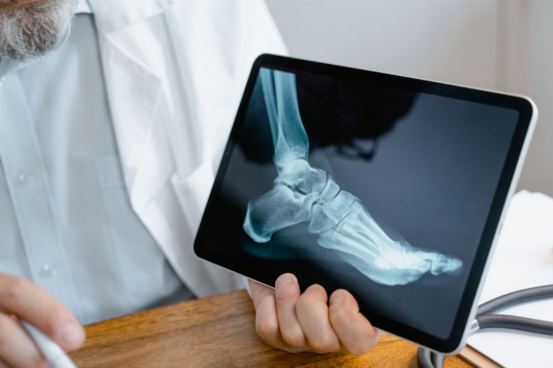 Femur Kırığı Ameliyatı Sonrası Bacakta Yamulma Neden Olur ve Tehlikeli mi?