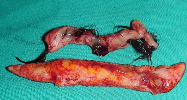 Kıl Dönmesi (Pilonoidal sinus)