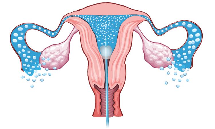 Histerosalpingografi (HSG)- Rahim Filmi