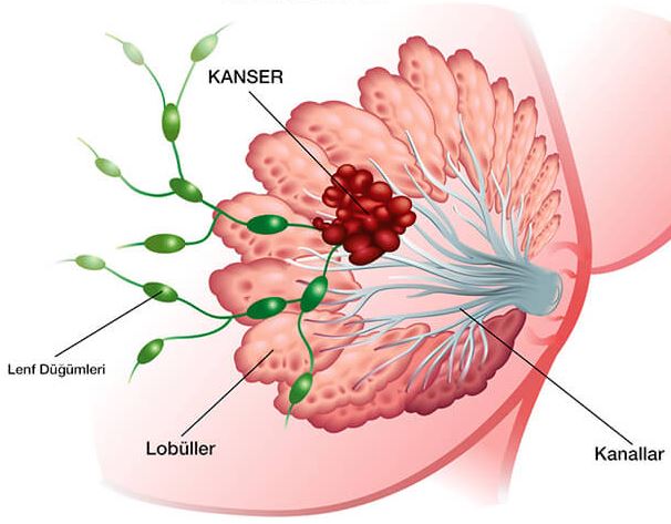 Meme Kanseri İle İlgili Önemli Bilgiler