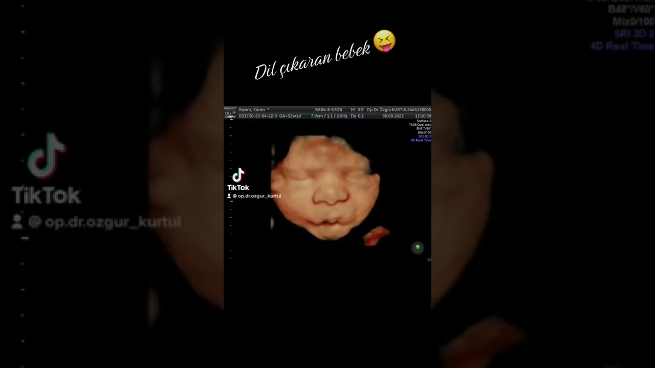 ?Dil çıkaran bebek ?